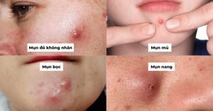 Phân biệt mụn viêm và mụn không viêm