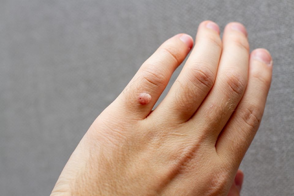 các loại mụn cóc