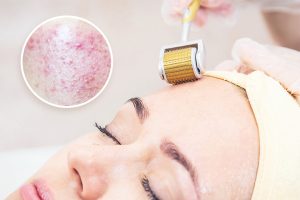 Phân biệt mụn viêm và mụn không viêm: Phương pháp lăn kim trị mụn