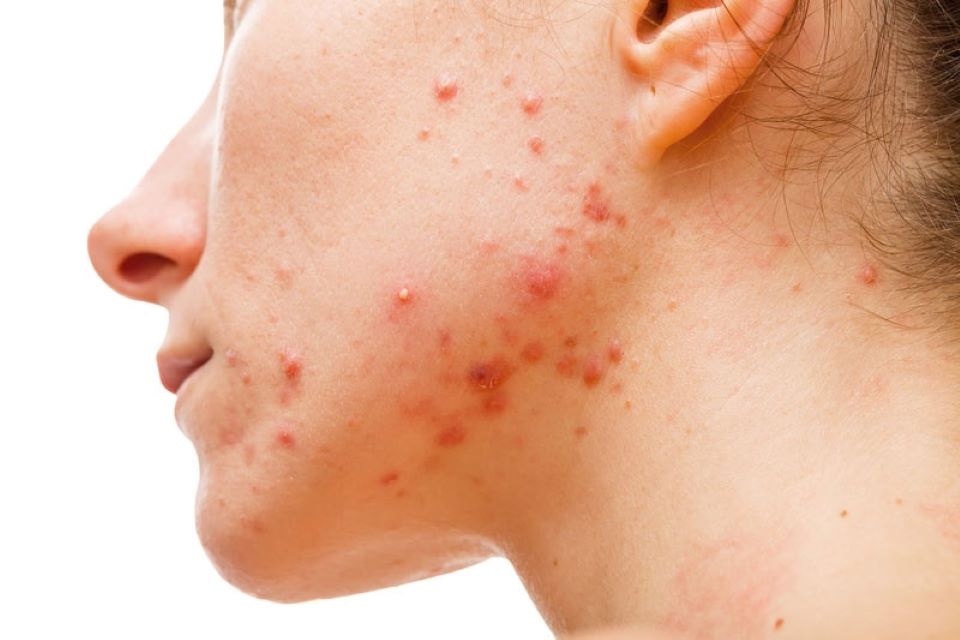 Điều trị các loại mụn trứng cá