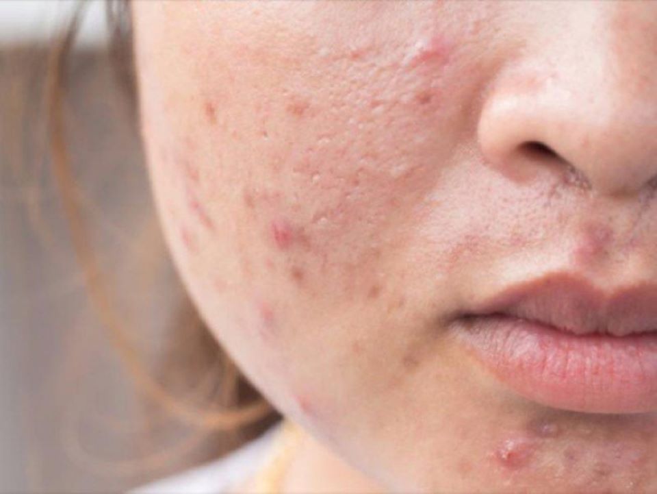Mụn trứng cá do biến đổi hormone trong cơ thể
