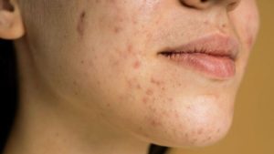 Phân biệt mụn ẩn và mụn cám