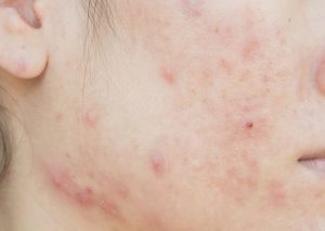 Phân biệt mụn ẩn và mụn cám