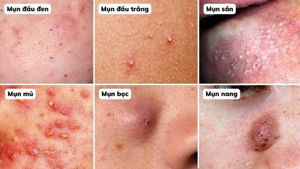Các loại mụn trứng cá thường gặp