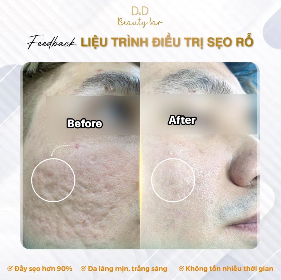 Kết quả peel da trị sẹo rỗ tại D.D Beauty Bar