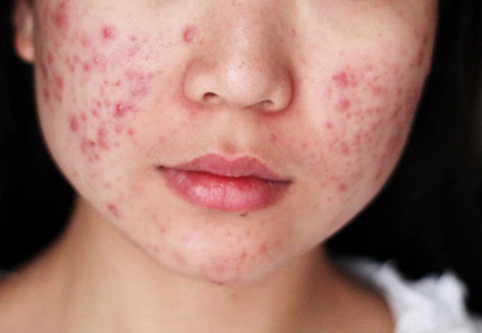 nguyên nhân gây mụn viêm