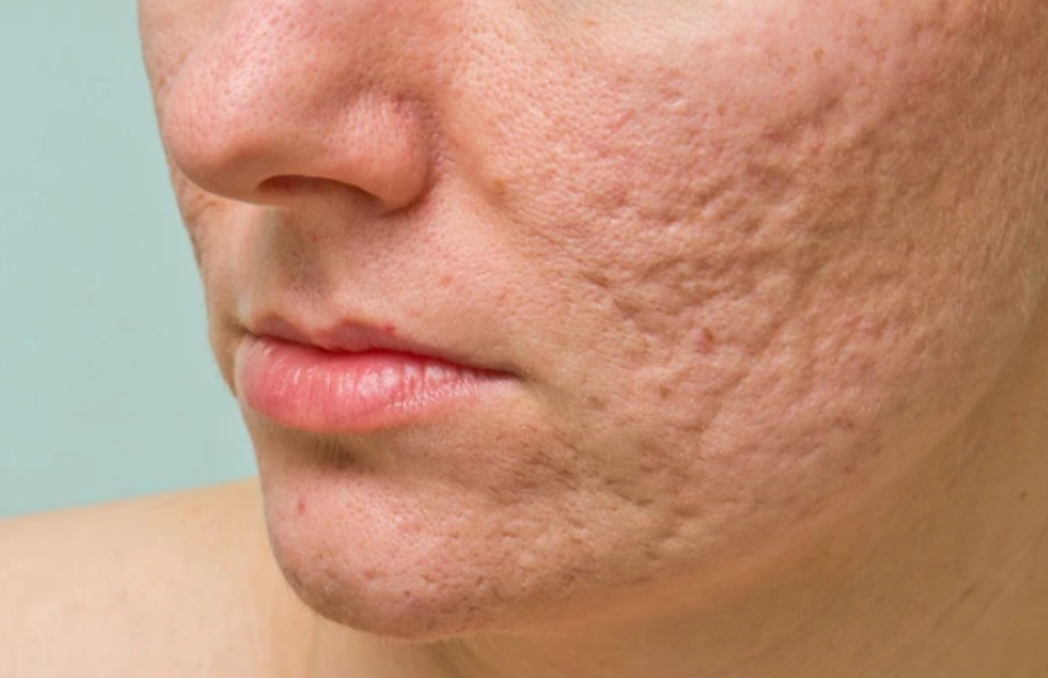Peel da trị sẹo rỗ