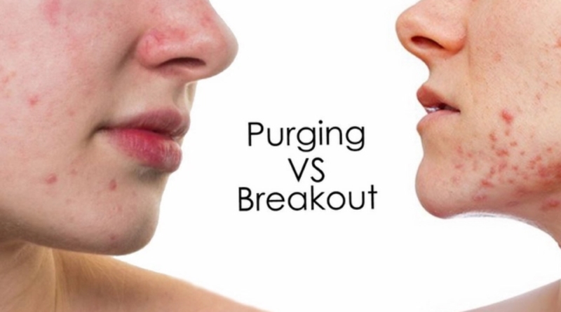 Phân biệt đẩy mụn và kích ứng