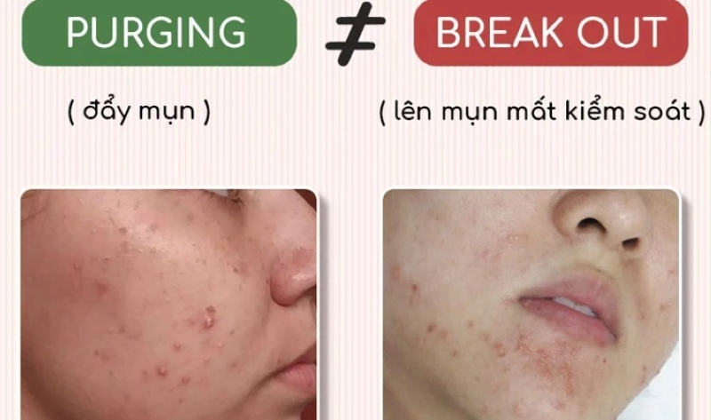 Phân biệt đẩy mụn và kích ứng