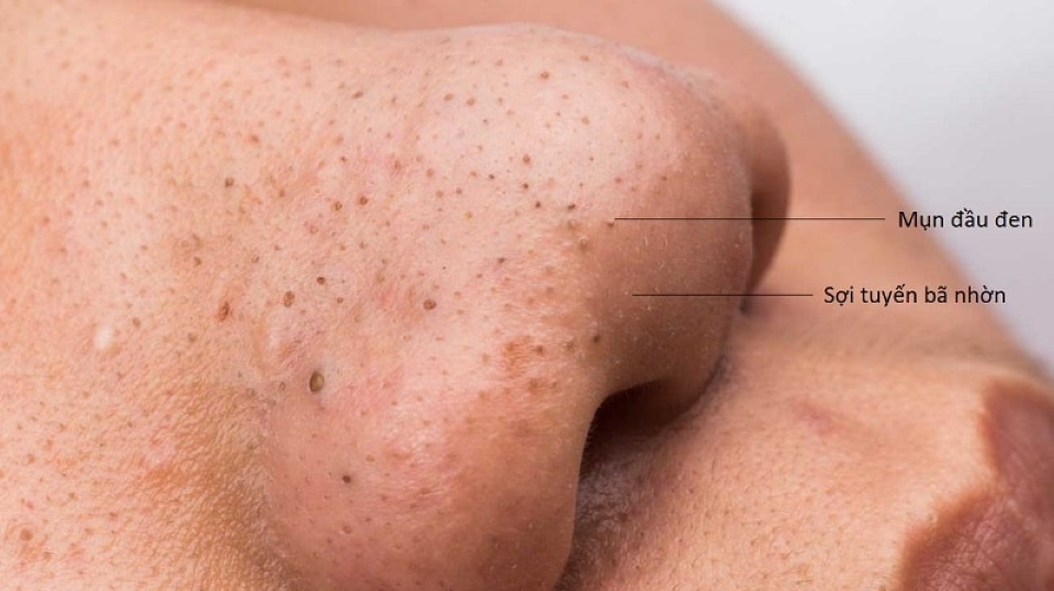 Cách phân biệt mụn đầu đen và sợi bã nhờn bằng mắt thường