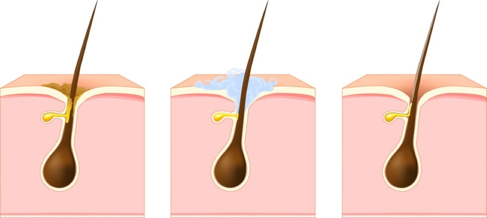 Nguyên nhân gây mụn viêm đỏ - Tắc nghẽn lỗ chân lông do dầu nhờn