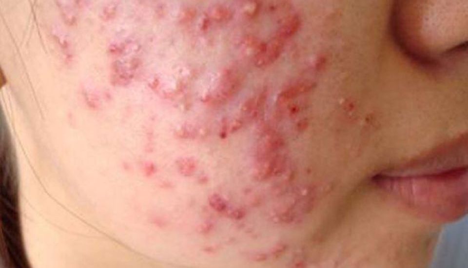 Cách trị mụn tuổi dậy thì - làm sao để hết mụn tuổi dậy thì đúng cách