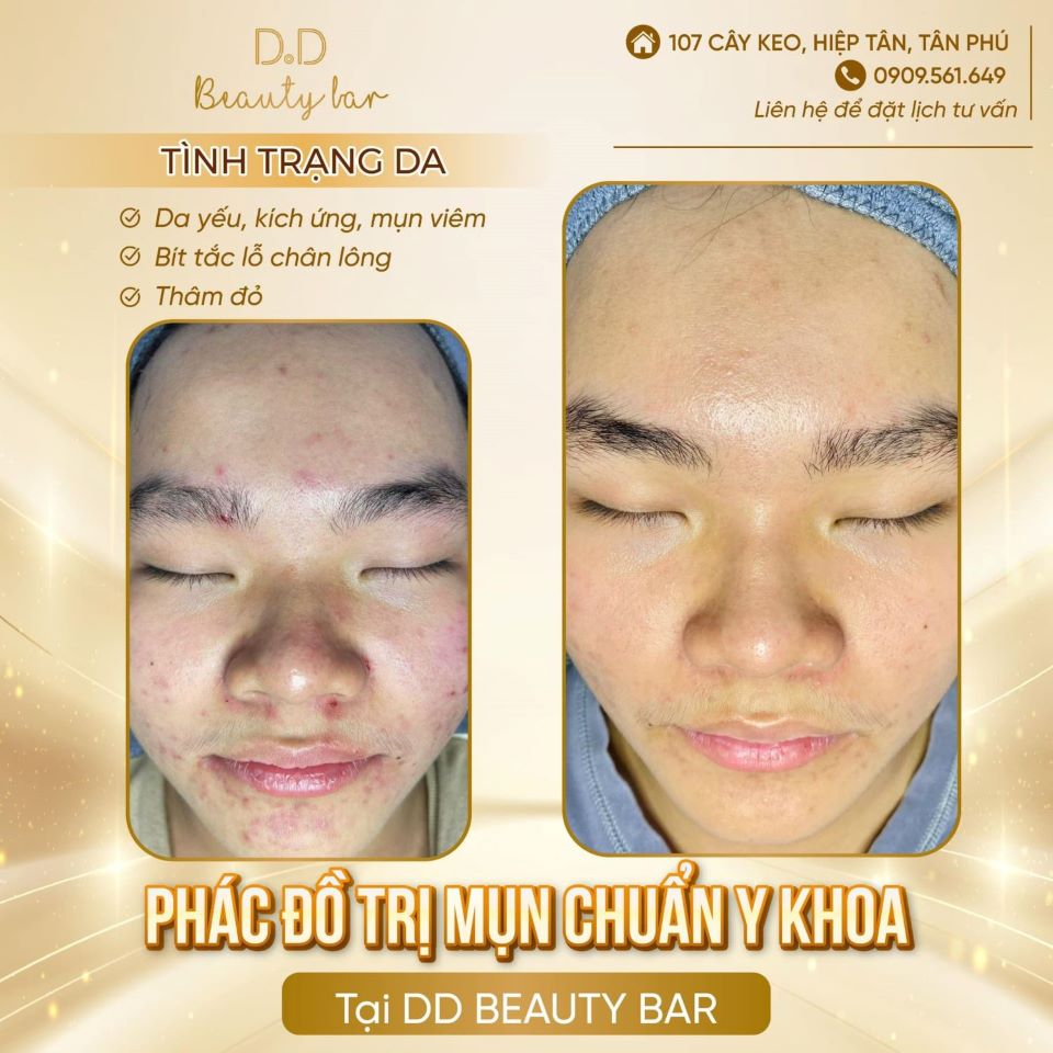 Làm sao để hết mụn tuổi dậy thì – D.D Beauty Bar có phác đồ trị mụn chuẩn y khoa