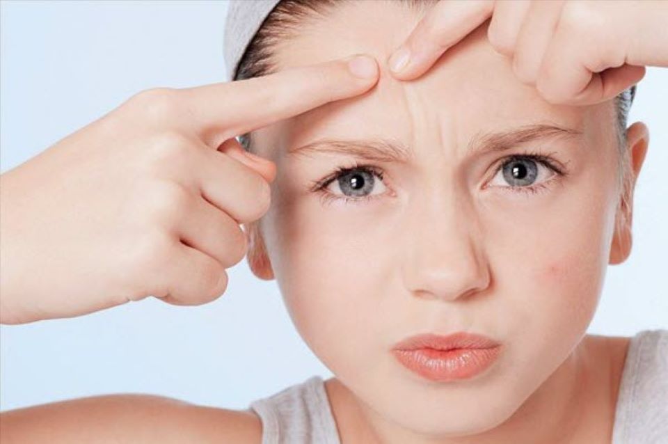 Có nên tự ý nặn mụn ẩn ở trán không?