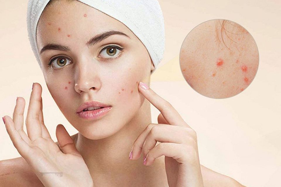 kiến thức chuyên sâu về da mụn