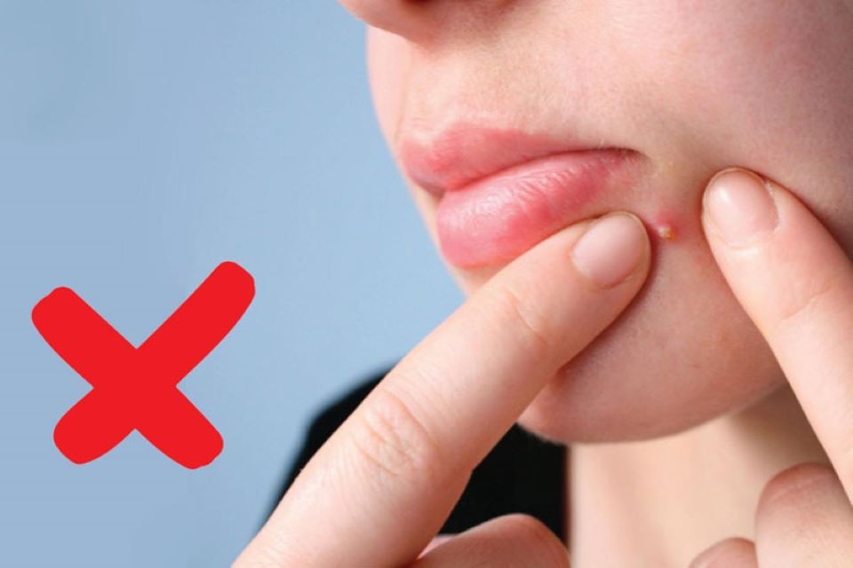 Những sai lầm phổ biến khi chăm sóc da mụn: Tự nặn mụn