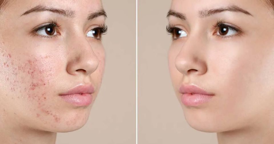 Da dầu mụn có nên peel da không? - Lợi ích khi peel da đối với da dầu mụn
