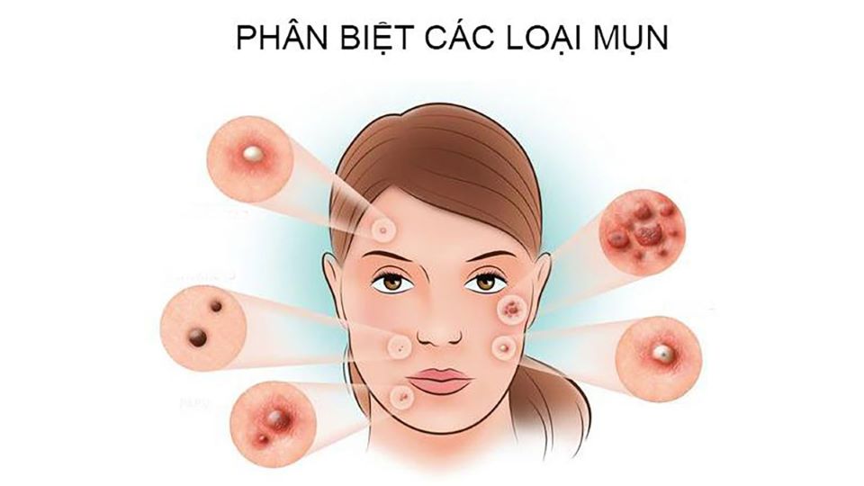 Kiến thức chuyên sâu về da mụn: Phân biệt các loại mụn