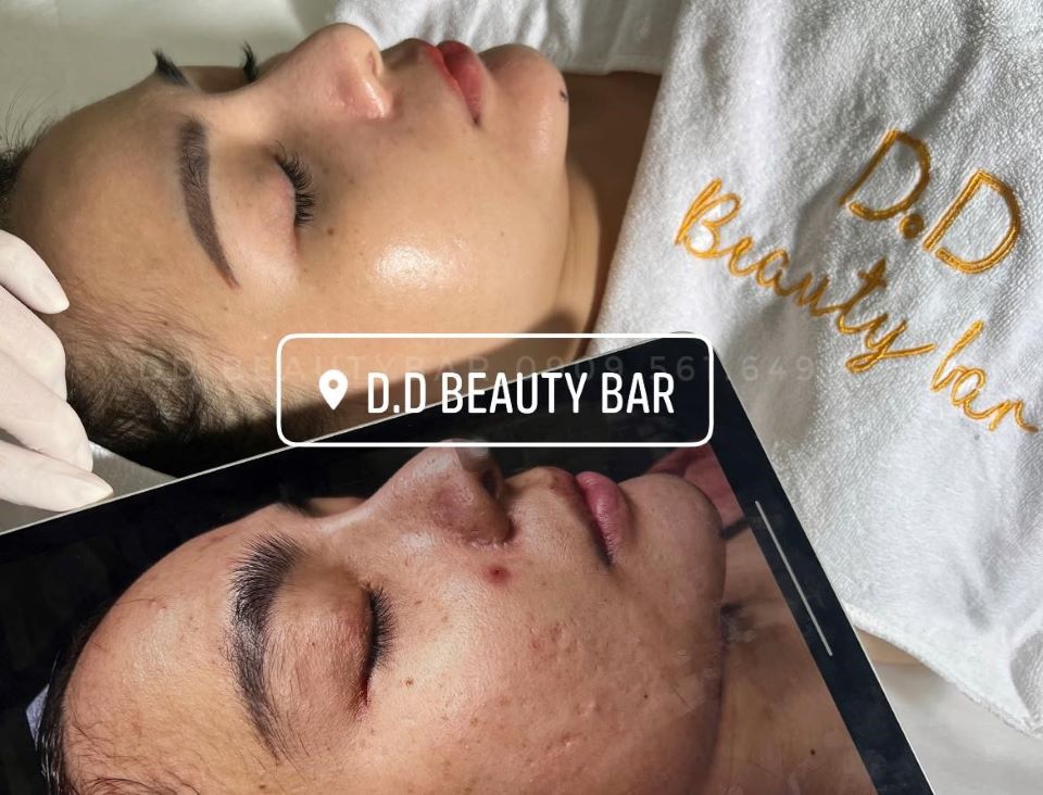 Peel da đẩy mụn có thực sự hiệu quả?
