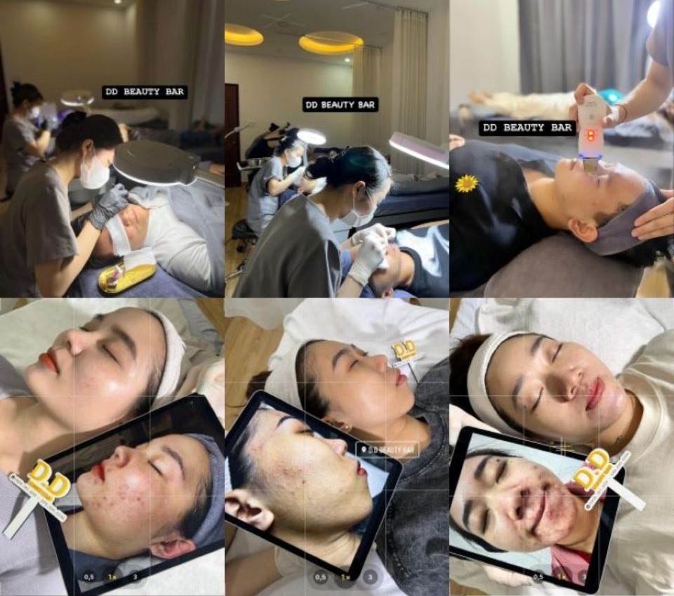 Quy trình 9 bước lấy nhân mụn chuẩn y khoa chỉ 149K tại D.D Beauty Bar
