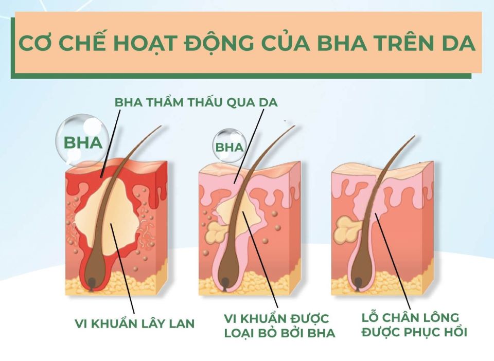 Cách điều trị mụn viêm đúng cách tại nhà