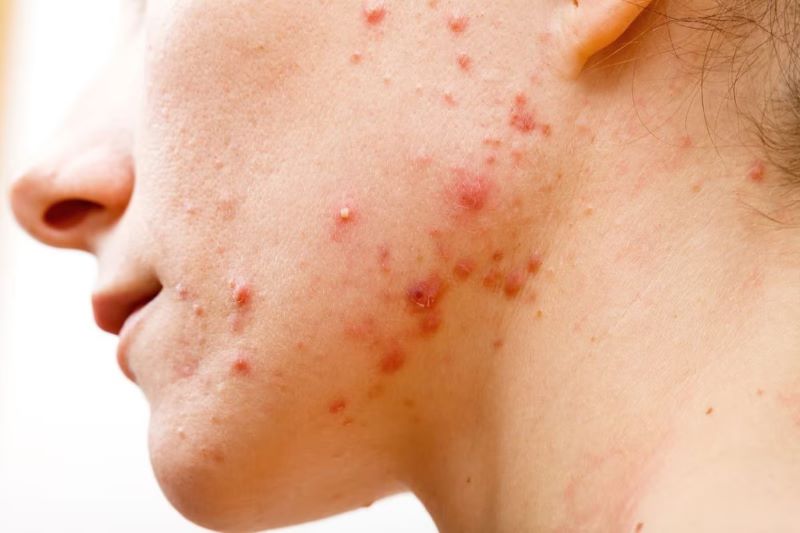 Các quy trình chăm sóc làn da mụn