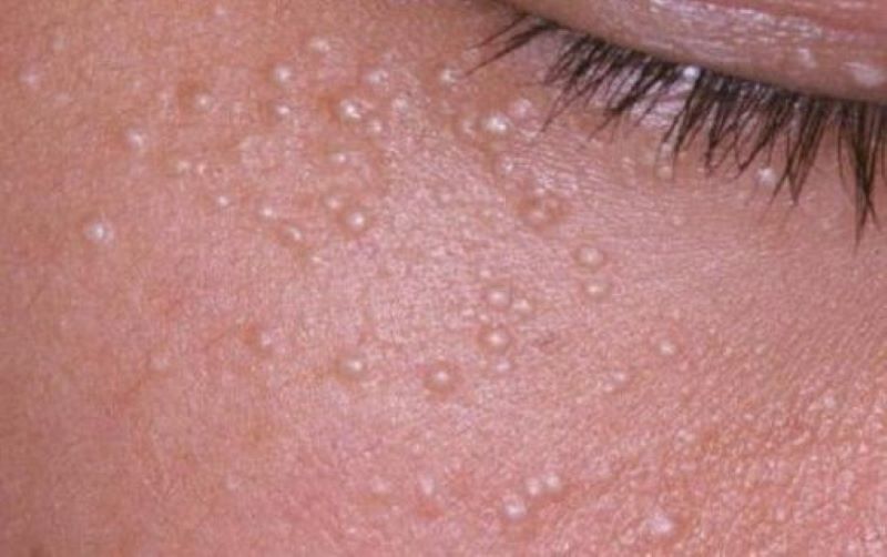 Cách trị mụn thịt 