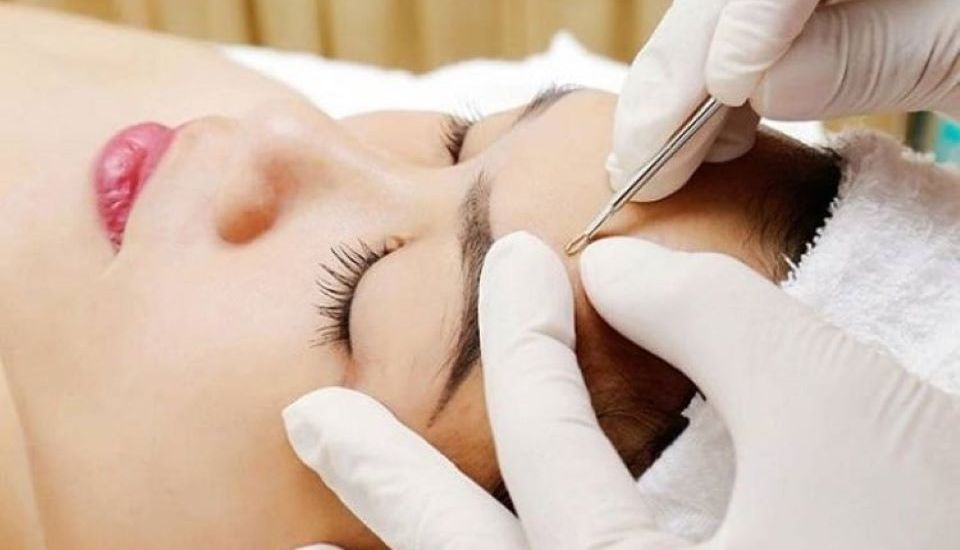 Lấy nhân mụn chuẩn y khoa là gì?