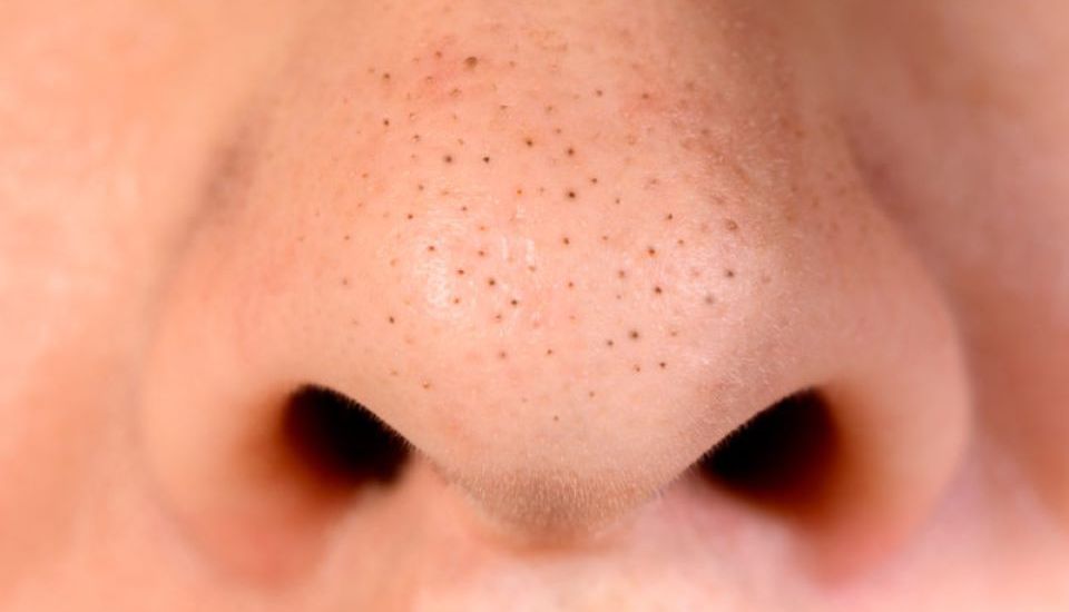 Các loại mụn phù hợp với quy trình lấy nhân mụn chuẩn y khoa