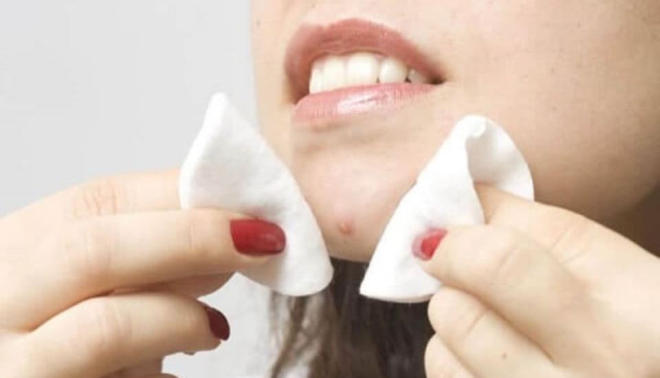 Có nên tự lấy nhân mụn tại nhà không? Những rủi ro cần tránh