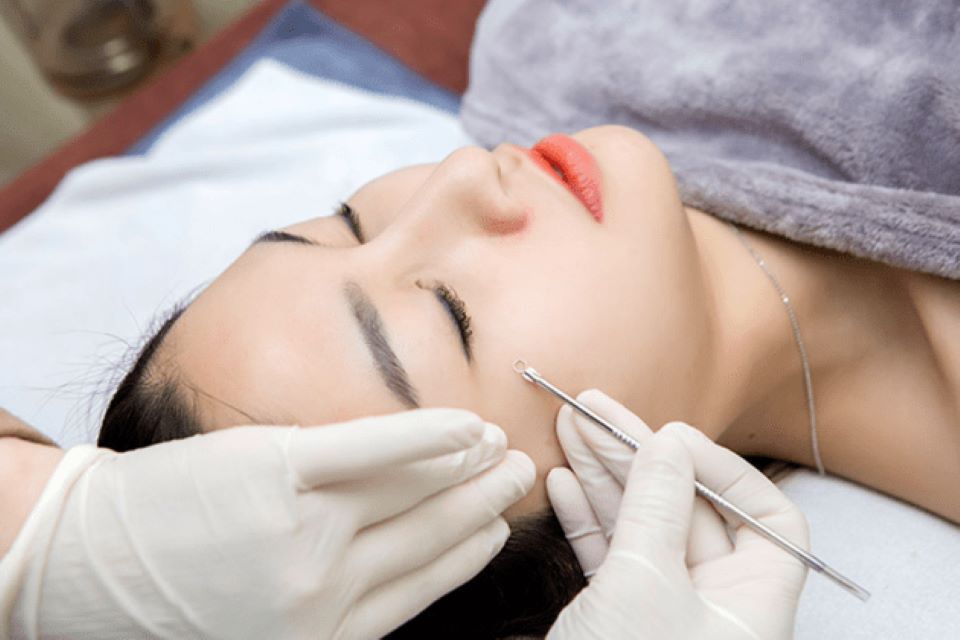 Có nên lấy nhân mụn không? Lợi ích của việc lấy nhân mụn