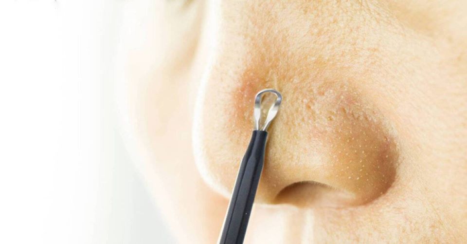 Có nên lấy nhân mụn không? Rủi ro của việc lấy nhân mụn không đúng cách