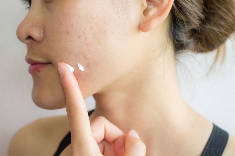 quy trình chăm sóc da mụn đúng cách 