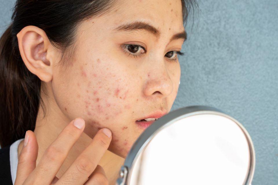 Sai lầm khi chăm sóc da mụn viêm sẽ dẫn đến hậu quả nghiêm trọng