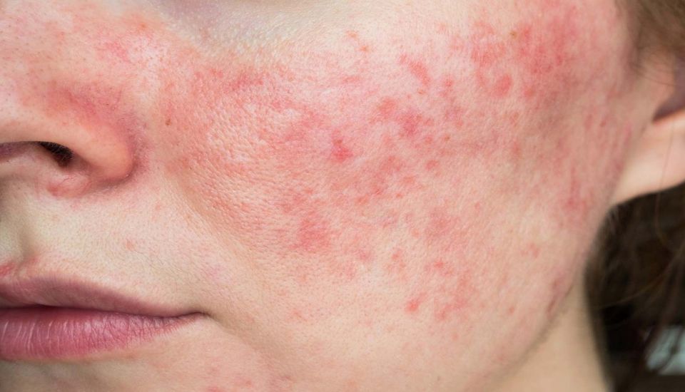 Da bị kích ứng có tự hết không?