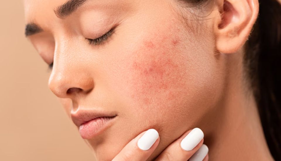 Da bị kích ứng có tự hết không? Nguyên nhân và cách điều trị