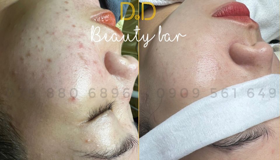 D.D Beauty Bar - Địa chỉ uy tín cho dịch vụ chăm sóc da chuyên nghiệp