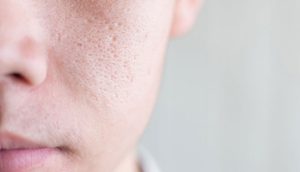 9 bí quyết se khít lỗ chân lông hiệu quả đơn giản